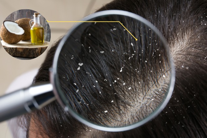 Dầu dừa có công dụng gì mang đến tóc: Hỗ trợ trị gàu