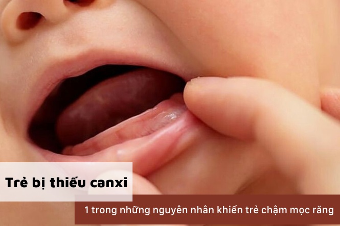 Cách kiểm tra trẻ thiếu canxi: Kiểm tra tiến độ mọc răng của trẻ