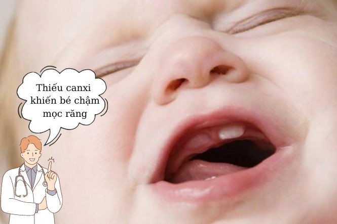 Thiếu canxi gây bệnh gì: Trẻ chậm mọc răng