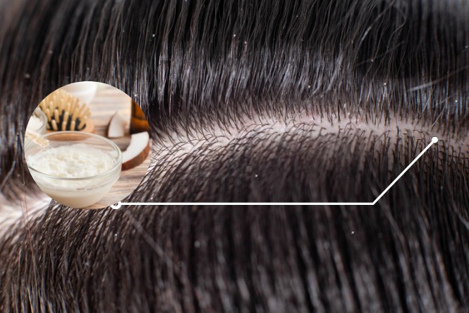 Dầu dừa có tác dụng gì với tóc: Trị gàu