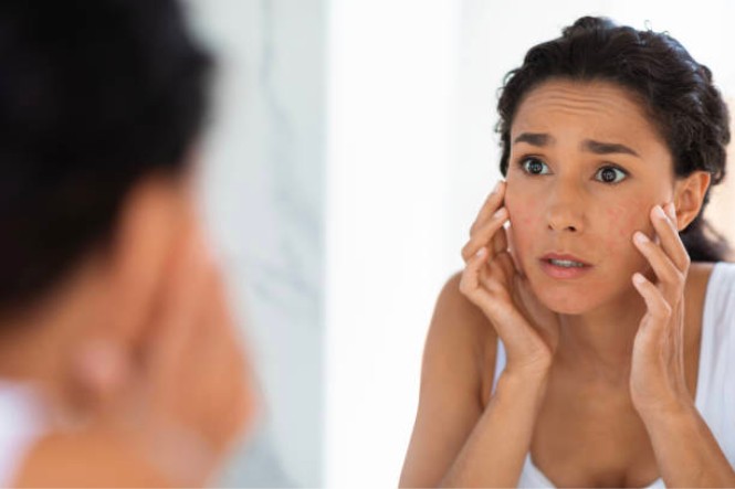 Tác hại của nha đam với da mặt: Bị kích ứng da
