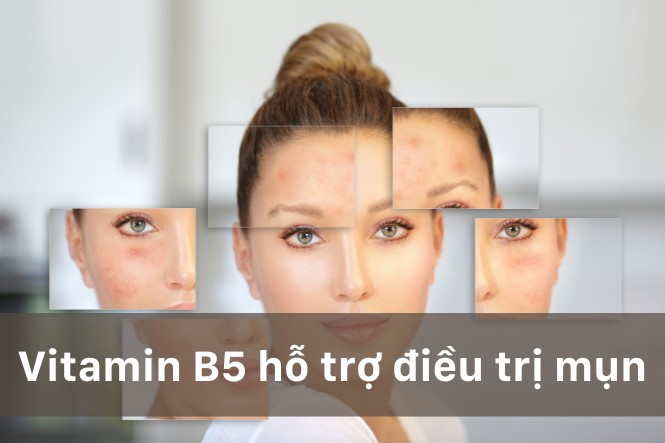 Vitamin B5 hỗ trợ điều trị mụn