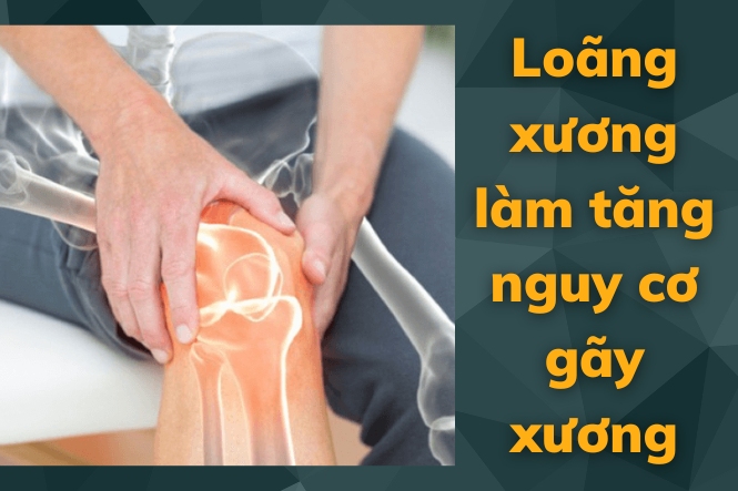 Loãng xương làm tăng nguy cơ xảy ra gãy xương