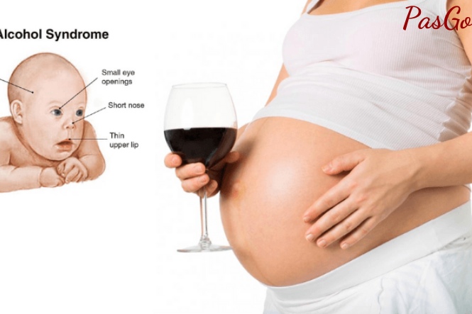 Hội chứng rượu bào thai gây ra nhiều dị tật cho trẻ nhỏ