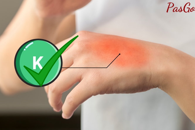 Bổ sung đủ vitamin K giúp làm dịu các vết dị ứng hoặc vết chàm