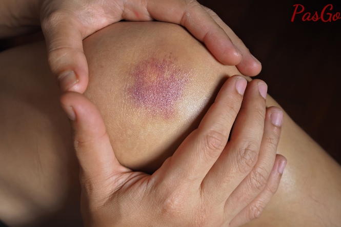 Thiếu hụt vitamin K khiến bạn dễ bị bầm tím khi va đập