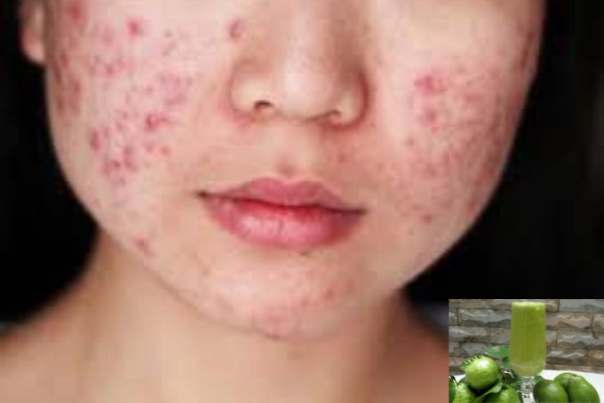 Uống nước ép cóc không gây nổi mụn