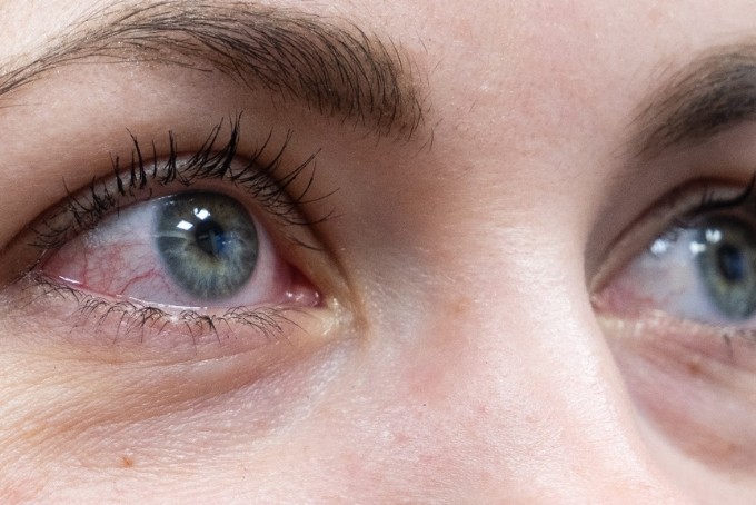 Đau mắt đỏ bao lâu thì khỏi 2